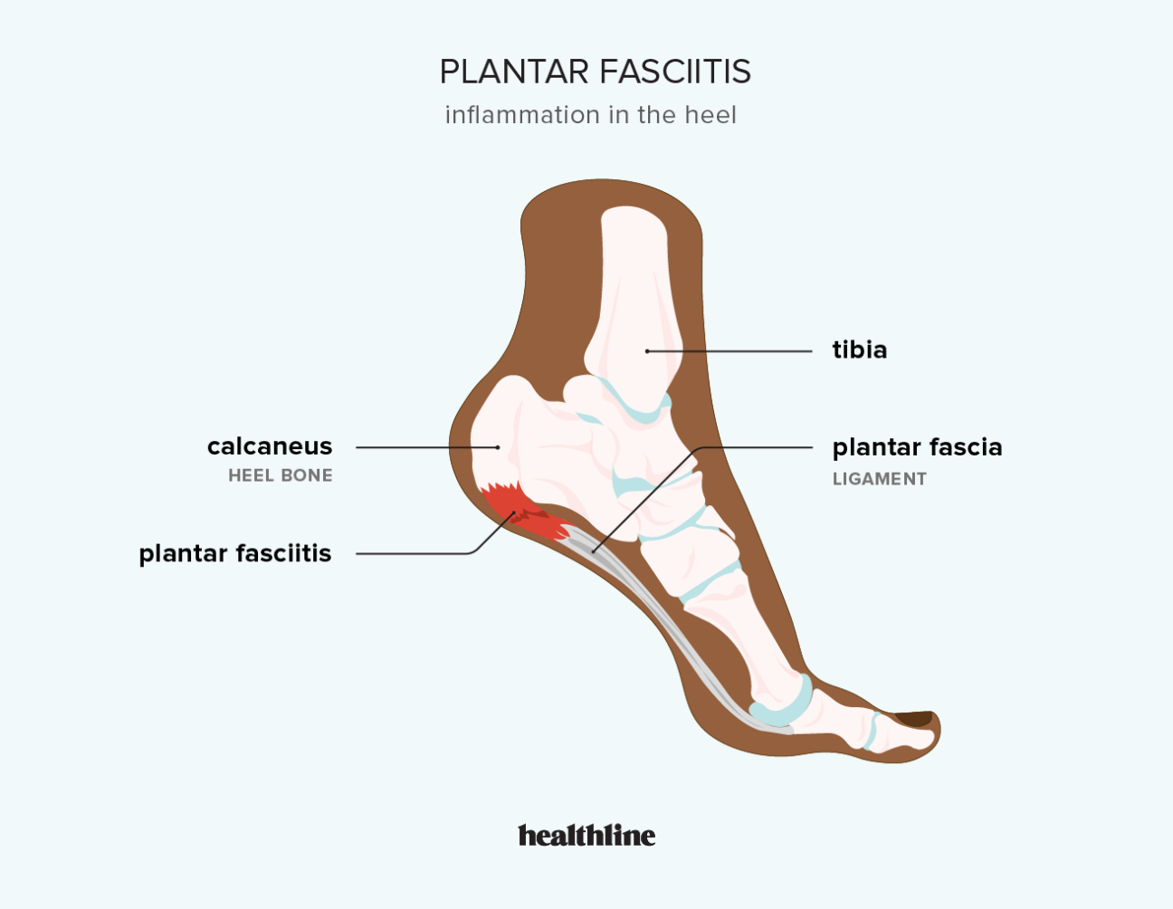 Best Relief For Plantar Fasciitis Online | bellvalefarms.com