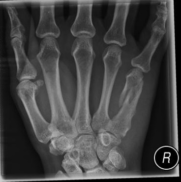 Metacarpal fractures – Orthopaedia: Hand