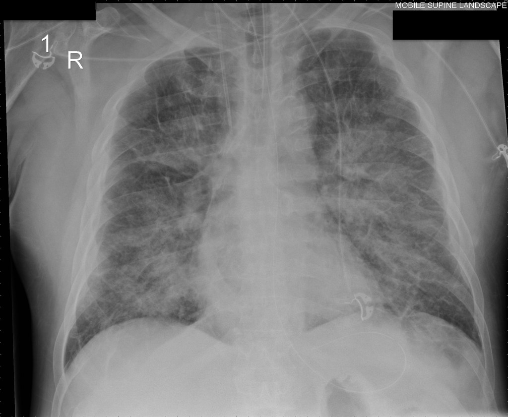 Pulmonary Edema X Ray Acute Pulmonary Edema Image | Images and Photos ...