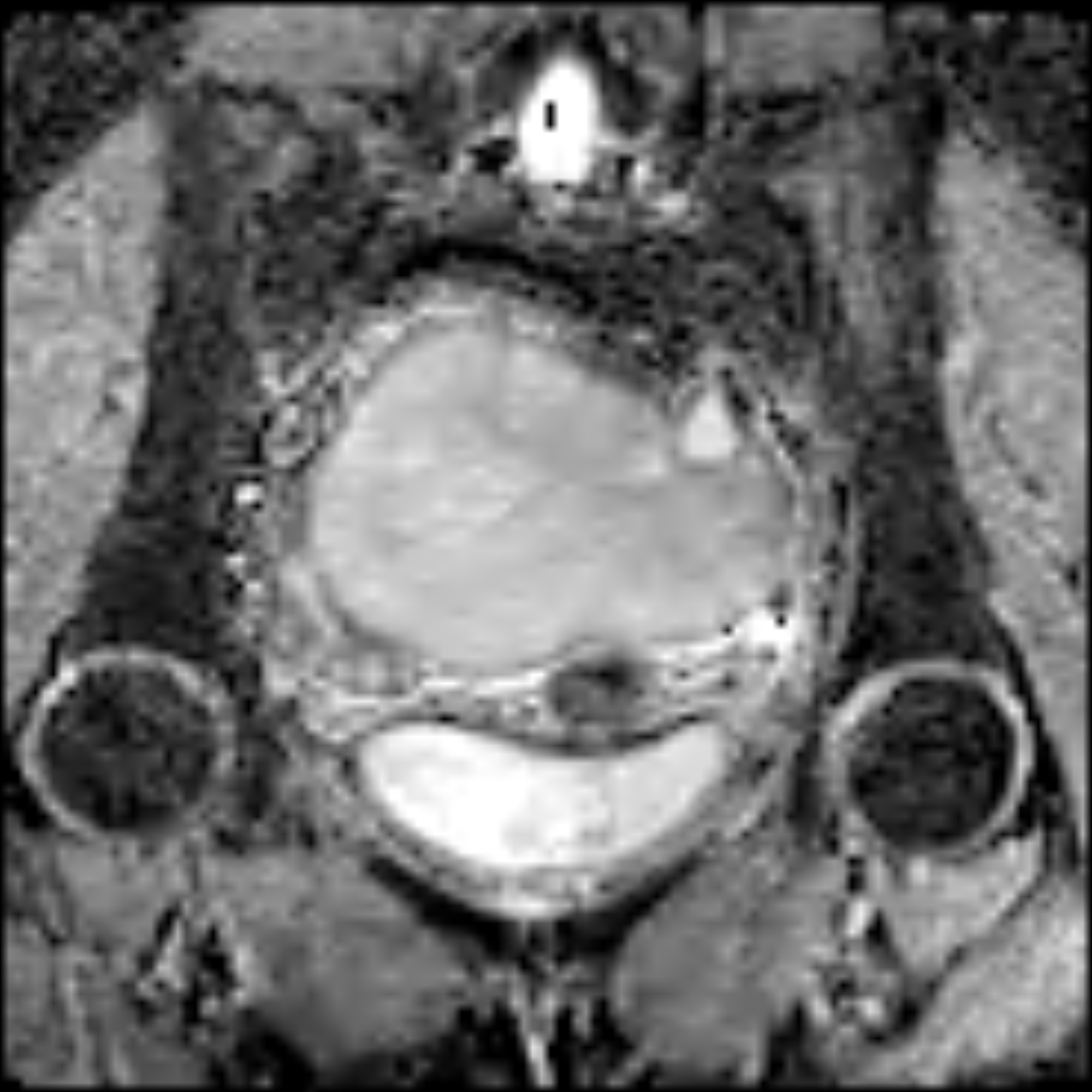 Ovarian Torsion Symptoms