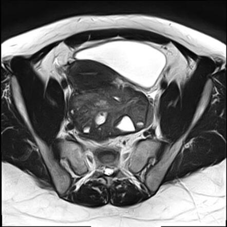 Ovarian torsion | Radiology Case | Radiopaedia.org