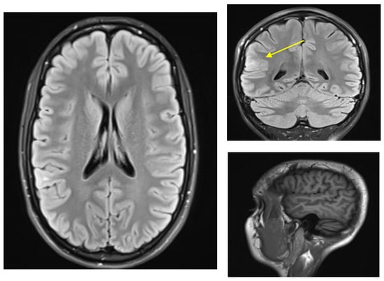 Life | Free Full-Text | The Possibility of Eidetic Memory in a Patient ...