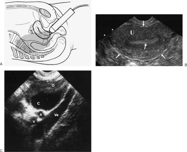 Transvaginal Ultrasound Diagram | My XXX Hot Girl