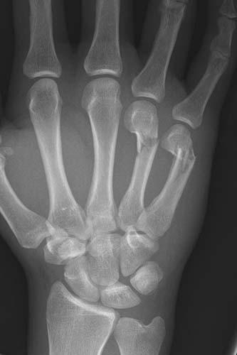 Hand | Radiology Key