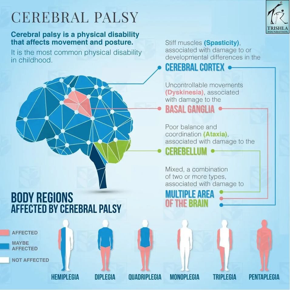 Cerebral Palsy Brain