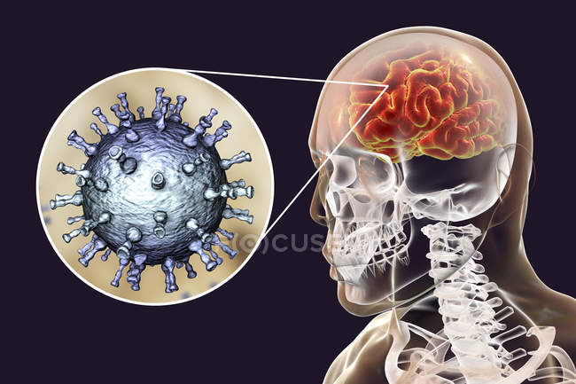 Konzeptionelle digitale Illustration der Enzephalitis durch Varizella-Zoster-Virus. — Stockfoto