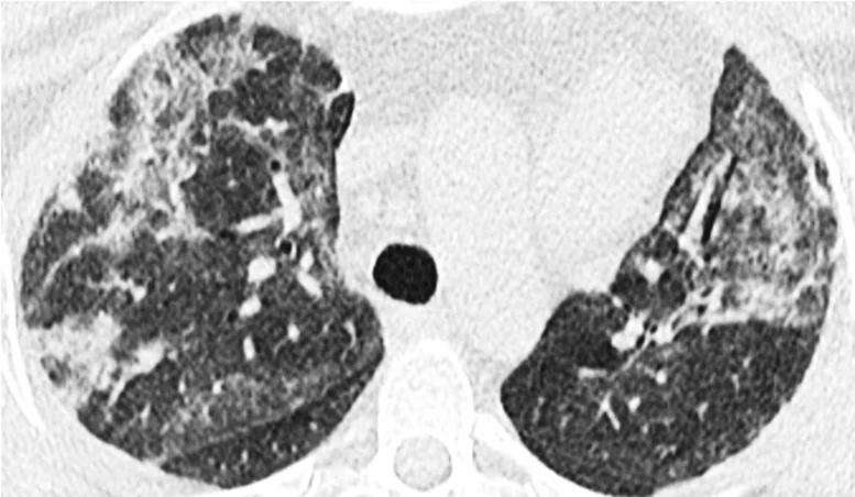 High-Resolution-Computed-Tomography-of-the-Lungs-of-a-Patient-With-a-Fatal-Case-of-MDA5-Autoimmunity-and-Interstitial-Pneumonitis-Contemporaneous.webp