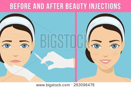 Womens Anti-aging Skin Care. Different Types Of Facial Wrinkles. Woman Before And After Botox Inject