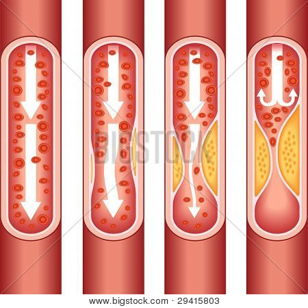 ウィーン人間 atherosclerosis.the 静脈の構造を。静脈の疾患の症状に