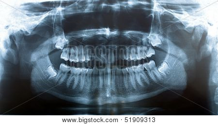 Picture X-ray Jaw