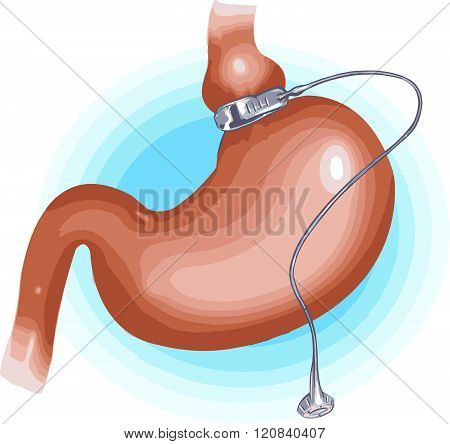 Gastric Band Weight Loss Surgery