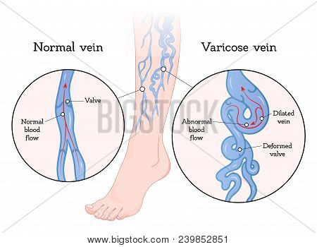 Varicose Veins Poster. Vein Enlarged And Twisted, Blue Blood Vessel Visible Through The Skin, Abnorm