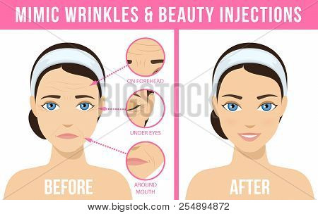 Women S Anti-aging Skin Care. Different Types Of Facial Wrinkles. Woman Before And After Botox Injec