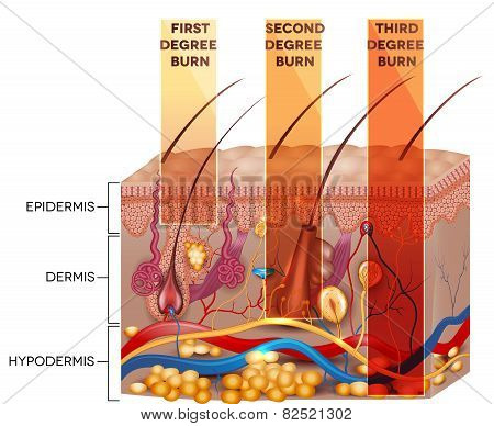 Skin Burn Classification. First, Second And Third Degree Skin Burns