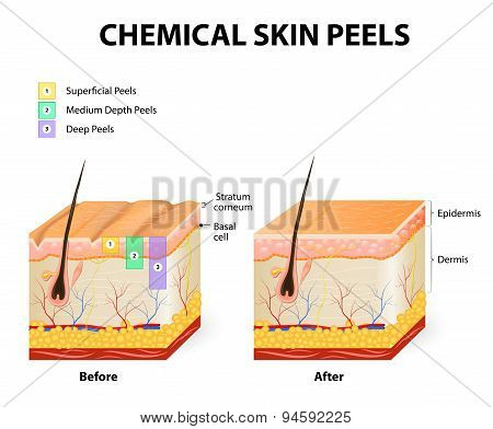 Chemical Peels