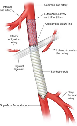 Combined Iliac Stent With Femoral Endarterectomy Thoracic Key | My XXX ...