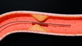 Blocked Artery, Collapsed balloon angioplasty procedure with Coronary stent in vein, blood flow circulation, vessels,