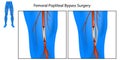 Femoral Popliteal Bypass Surgery. Leg Artery Bypass Surgery Diagram. Medical Chart of the Procedure for Leg Artery