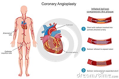 Coronary angioplasty opens blocked heart arteries with a balloon and stent to restore blood flow Vector Illustration