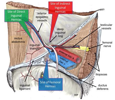 Direct And Indirect Inguinal Hernia