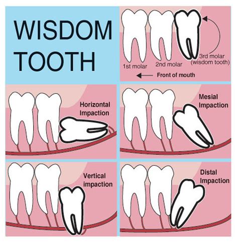 When Do Wisdom Teeth Need To Be Removed My Best Dentists Journal