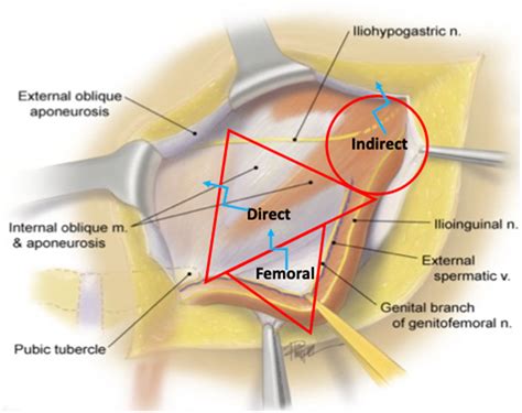 Indirect Vs Direct Inguinal Hernia