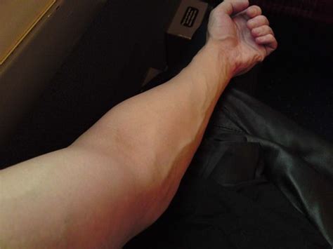 What causes enlarged veins in the arm? Years of heavy weight exercises (gym) are making my veins ...