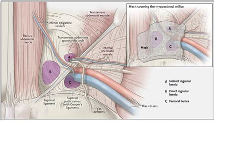 Direct Vs Indirect Inguinal Hernia JermainetaroHuerta