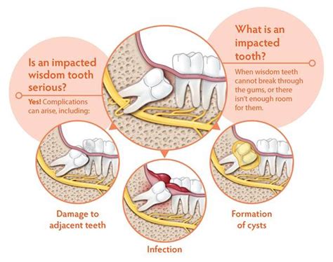 Diagram Of Teeth With Wisdom Teeth Teeth Poster