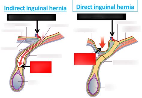 Diagram Of Indirect And Direct Inguinal Hernias Quizlet