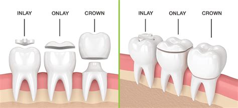 Cerec Same Day Restorations In Gosford 7 Days Vc Dental