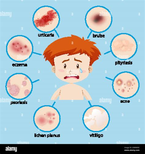 Skin Conditions Children Stock Vector Images Alamy