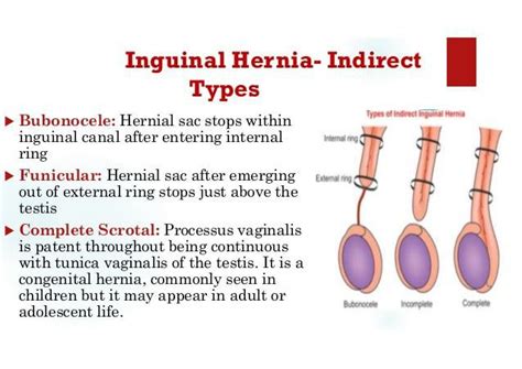 Classification Of Indirect Inguinal Hernia MEDizzy