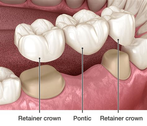 Dental Bridges Gosford Affordable Finance Available Vc Dental