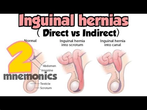 Inguinal Hernias Direct Inguinal Hernia Indirect Inguinal Hernia YouTube