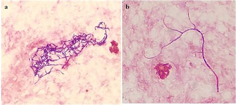 Corynebacterium Ulcerans As Filamentous Branching Rods Clinical