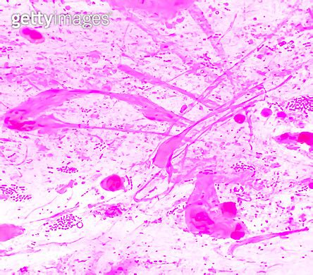 Wound Swab Or Pus Gram Stain Microscopic X Objective Show Gram