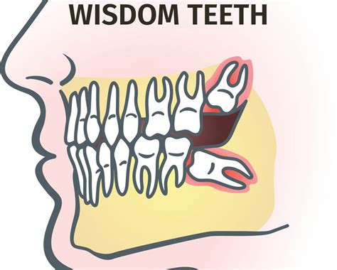 Wisdom Teeth Diagram