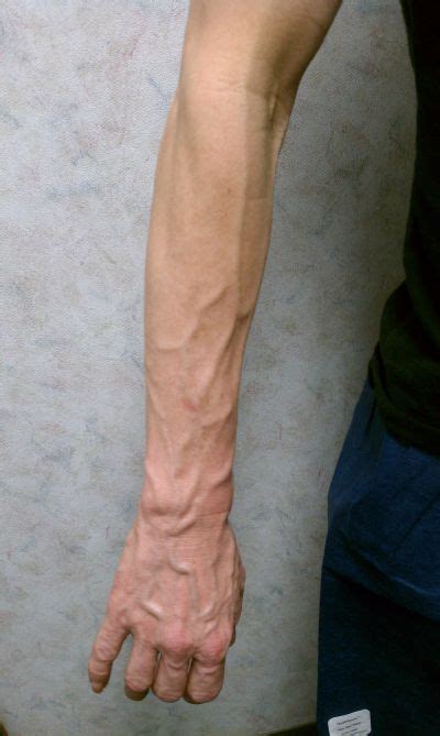 What causes veins to pop out? How to Get Rid Of Varicose Veins In Your Arms