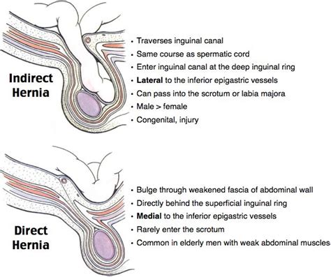 Indirect Vs Direct Hernia Inguinal Hernias Bimodal 40 Direct