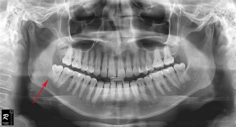 Wisdom Teeth Surgery Cases That Was Done In Our Clinic Prestige