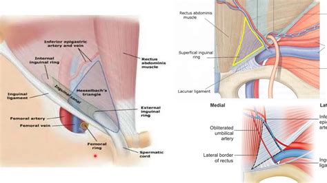 Inguinal Canal Direct Indirect Inguinal Hernia Hesselbachs Triangle