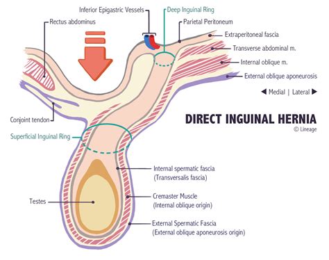 Indirect Vs Direct Inguinal Hernia