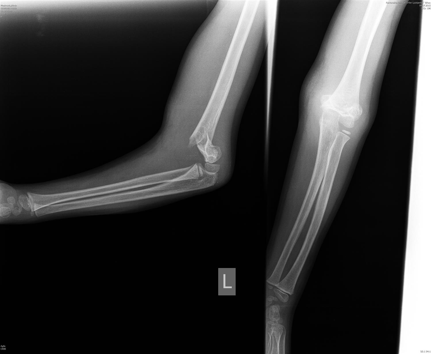 Supracondylar fracture humerus - coastalkowern