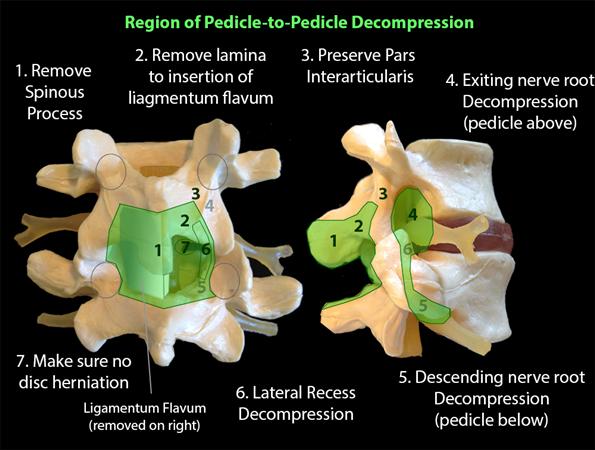 Lateral Recess Lumbar