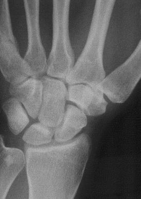 Basilar Thumb Arthritis - Hand - Orthobullets.com