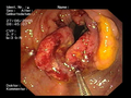 Endoscopy images