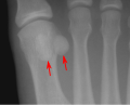 Sesamoid Bones Of Foot