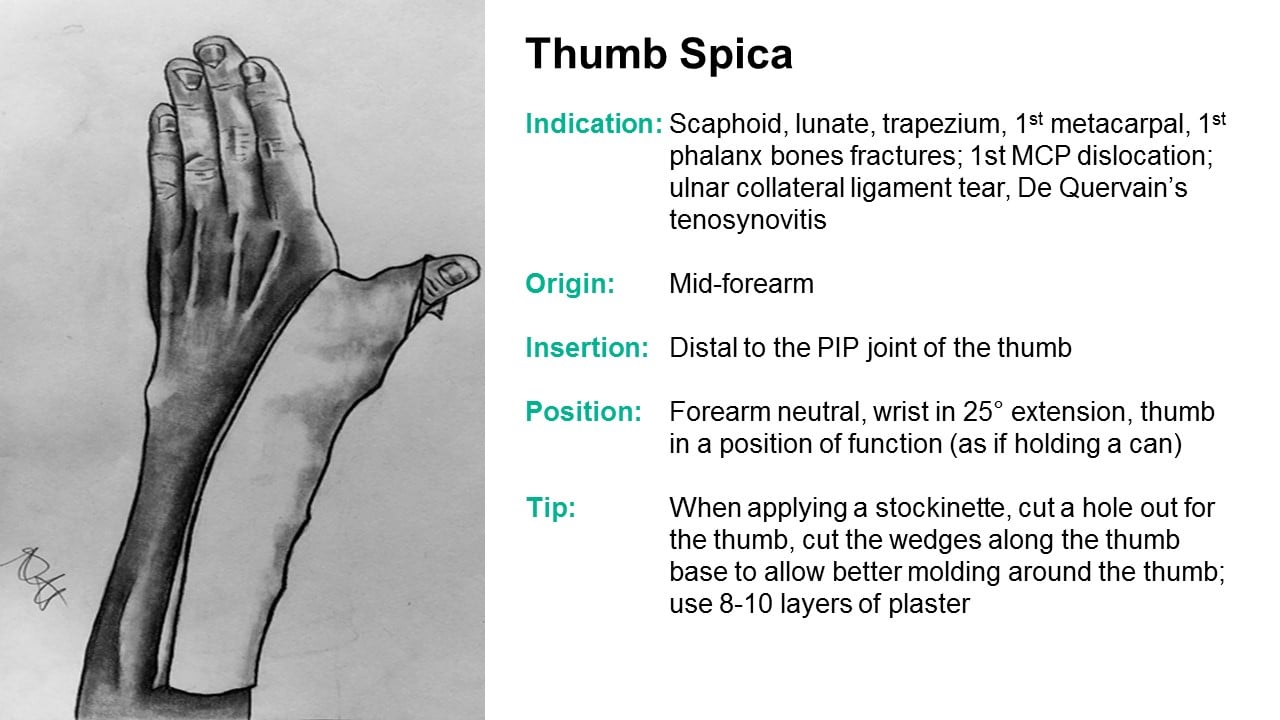 Scaphoid Fracture Cast Position