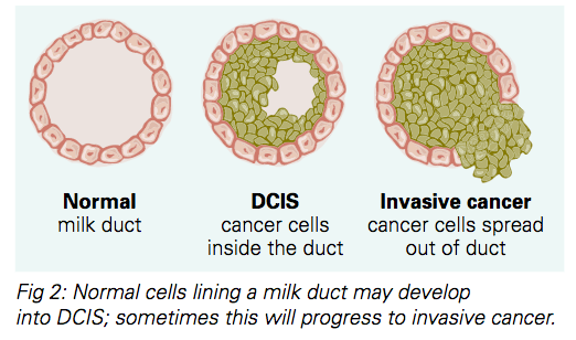 Invasive Ductal Carcinoma (IDC) National Breast Cancer, 52% OFF